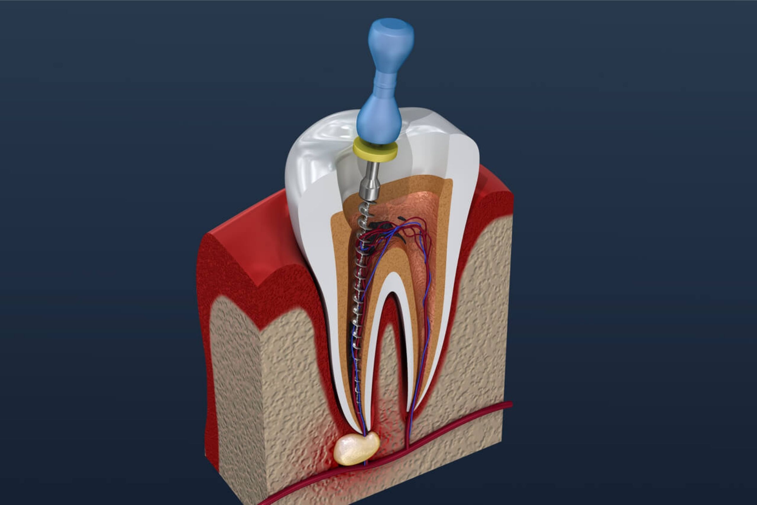 Endodonti (Kanal Tedavisi)