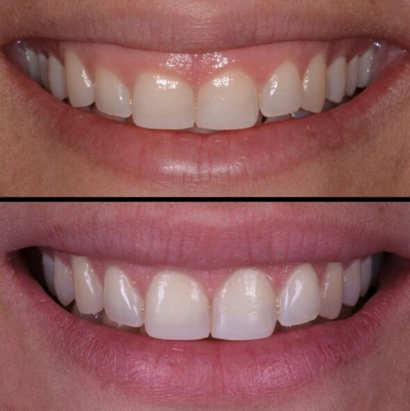 Gummy Smile tedavisi nedir?